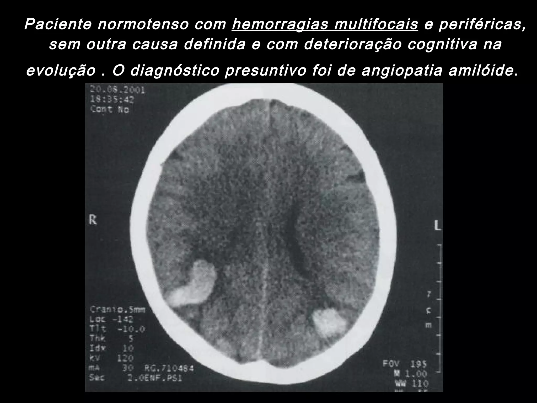 Paciente normotenso com  hemorragias multifocais  e periféricas, sem outra causa definida e com deterioração cognitiva na evolução . O diagnóstico presuntivo foi de angiopatia amilóide.   