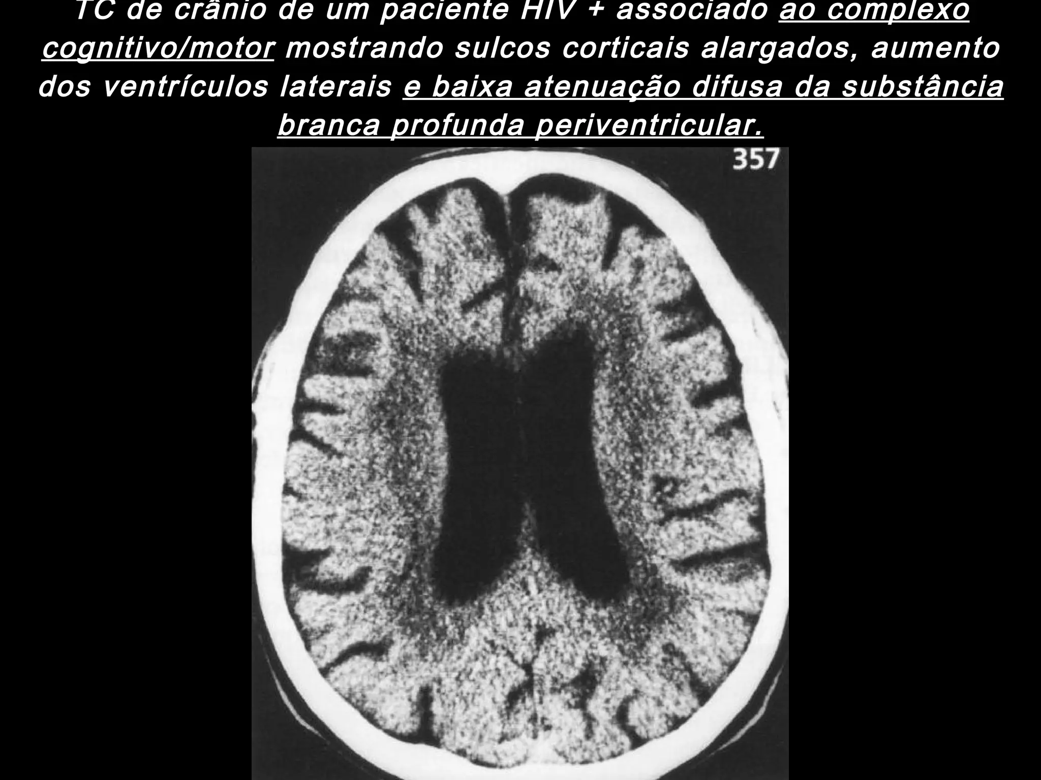 TC de crânio de um paciente HIV + associado  ao complexo cognitivo/motor  mostrando sulcos corticais alargados, aumento dos ventrículos laterais  e baixa atenuação difusa da substância branca profunda periventricular. 