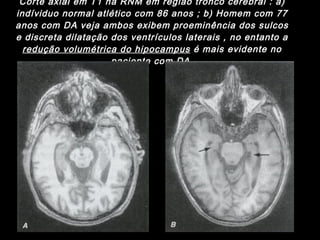 Corte axial em T1 na RNM em região tronco cerebral : a) indíviduo normal atlético com 86 anos ; b) Homem com 77 anos com DA veja ambos exibem proeminência dos sulcos e discreta dilatação dos ventrículos laterais , no entanto a  redução volumétrica do hipocampus  é mais evidente no paciente com DA. 