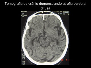 Tomografia de crânio demonstrando atrofia cerebral difusa 