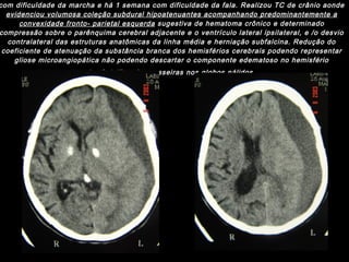 Paciente masculino,87 anos,  há 1 ano com história de queda da própria altura, há 2 meses com dificuldade da marcha e há 1 semana com dificuldade da fala. Realizou TC de crânio aonde  evidenciou volumosa coleção subdural hipoatenuantes acompanhando predominantemente a convexidade fronto- parietal esquerda  sugestiva de hematoma crônico e determinado compressão sobre o parênquima cerebral adjacente e o ventrículo lateral ipsilateral, e /o desvio contralateral das estruturas anatômicas da linha média e herniação subfalcina. Redução do coeficiente de atenuação da substância branca dos hemisférios cerebrais podendo representar gliose microangiopática não podendo descartar o componente edematoso no hemisfério esquerdo. Calcificação grosseiras nos globos pálidos.   