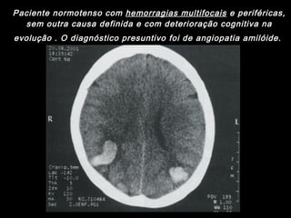 Paciente normotenso com  hemorragias multifocais  e periféricas, sem outra causa definida e com deterioração cognitiva na evolução . O diagnóstico presuntivo foi de angiopatia amilóide.   