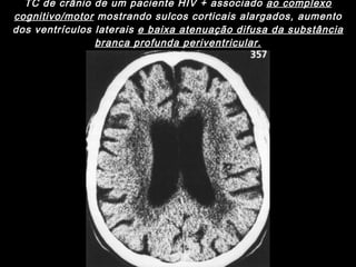 TC de crânio de um paciente HIV + associado  ao complexo cognitivo/motor  mostrando sulcos corticais alargados, aumento dos ventrículos laterais  e baixa atenuação difusa da substância branca profunda periventricular. 
