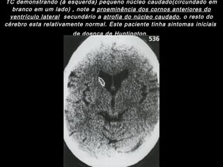 TC demonstrando (à esquerda) pequeno núcleo caudado(circundado em branco em um lado) , note a  proeminência dos cornos anteriores do ventrículo lateral   secundário a  atrofia do núcleo caudado , o resto do cérebro esta relativamente normal. Este paciente tinha sintomas iniciais  de doença de Huntington.   