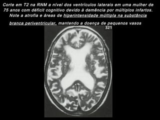 Corte em T2 na RNM a nível dos ventrículos laterais em uma mulher de 75 anos com déficit cognitivo devido à demência por múltiplos infartos. Note a atrofia e áreas de  hiperintensidade múltipla na substância branca periventricular,  mantendo a doença de pequenos vasos   