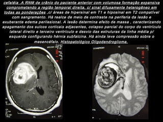 Paciente  com  25 anos  com distúrbio do comportamento , perda cognitiva  e cefaléia .A RNM de crânio do paciente anterior com volumosa formação expansiva comprometendo a região temporal direita, c/ sinal difusamente heterogêneo em todas as ponderações  ,c/ áreas de hipersinal em T1 e hiposinal em T2 compatível com sangramento. Há realce de meio de contraste na periferia da lesão e exuberante edema perilesional. A lesão determina efeito de massa , caracterizando apagamento dos sulcos corticais adjacentes, colapso parcial do corpo do ventrículo lateral direito e terceiro ventrículo e desvio das estruturas da linha média p/ esquerda configurando hérnia subfalcina. Há ainda leve compressão sobre o mesencéfalo.  Histopatológico Oligodendroglioma.   