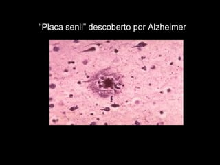 “ Placa senil” descoberto por Alzheimer  