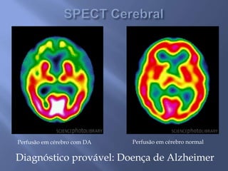 Perfusão em cérebro com DA Perfusão em cérebro normal
Diagnóstico provável: Doença de Alzheimer
 