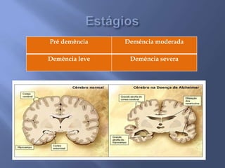 Pré demência Demência moderada
Demência leve Demência severa
 