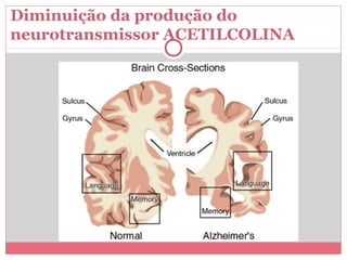 Diminuição da produção do 
neurotransmissor ACETILCOLINA 
 