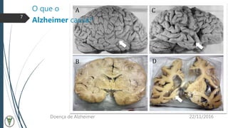 O que o
Alzheimer causa?
22/11/2016Doença de Alzheimer
7
 