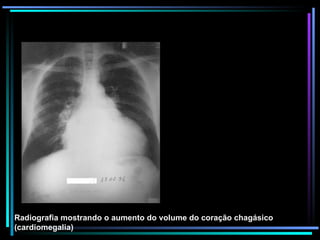 Radiografia mostrando o aumento do volume do coração chagásico (cardiomegalia) 