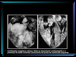 Cardiopatia chagásica crônica. Nota-se importante cardiomegalia e a presença de lesão vorticilar (aneurisma da ponta do ventrículo esquerdo 