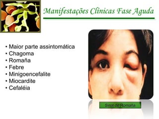 Manifestações Clínicas Fase Aguda  •  Maior parte assintomática •  Chagoma •  Romaña •  Febre •  Minigoencefalite •  Miocardite •  Cefaléia Sinal de Romaña 