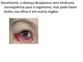 Geralmente, a doença desaparece sem nenhuma
 conseqüência para o organismo, mas pode haver
 lesões nos olhos e em outros órgãos.
 