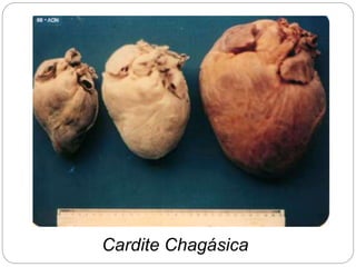 Cardite Chagásica
 