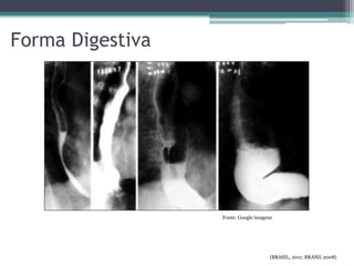 Forma Digestiva
(BRASIL, 2011; BRASIL 2008)
Fonte: Google imagens
 