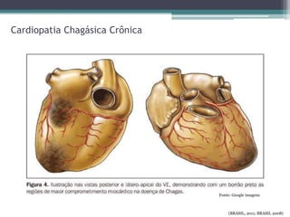 Cardiopatia Chagásica Crônica
Fonte: Google imagens
(BRASIL, 2011; BRASIL 2008)
 