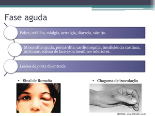 Fase aguda
Febre, cefaléia, mialgia, artralgia, diarreia, vômito.
Miocardite aguda, pericardite, cardiomegalia, insuficiência cardíaca,
arritmias, edema de face e/ou membros inferiores.
Lesões de porta de entrada
• Sinal de Romaña • Chagoma de inoculação
(BRASIL, 2011; BRASIL 2008)
 