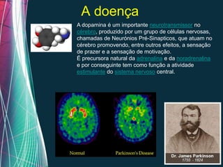 A doença
A dopamina é um importante neurotransmissor no
cérebro, produzido por um grupo de células nervosas,
chamadas de Neurónios Pré-Sinapticos, que atuam no
cérebro promovendo, entre outros efeitos, a sensação
de prazer e a sensação de motivação.
É precursora natural da adrenalina e da noradrenalina
e por conseguinte tem como função a atividade
estimulante do sistema nervoso central.




  Free Powerpoint Templates
                                              Page 2
 