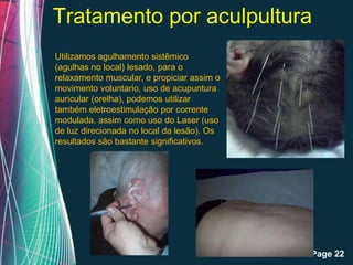 Tratamento por aculpultura
Utilizamos agulhamento sistêmico
(agulhas no local) lesado, para o
relaxamento muscular, e propiciar assim o
movimento voluntario, uso de acupuntura
auricular (orelha), podemos utilizar
também eletroestimulação por corrente
modulada, assim como uso do Laser (uso
de luz direcionada no local da lesão). Os
resultados são bastante significativos.




                   Free Powerpoint Templates
                                               Page 22
 