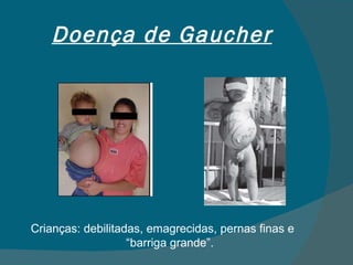 Doença de Gaucher Crianças: debilitadas, emagrecidas, pernas finas e “barriga grande”. 