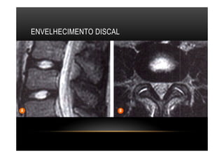 ENVELHECIMENTO DISCAL
 