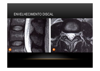 ENVELHECIMENTO DISCAL
 
