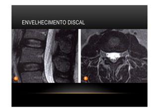 ENVELHECIMENTO DISCAL
 