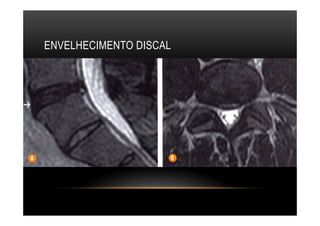 ENVELHECIMENTO DISCAL
 