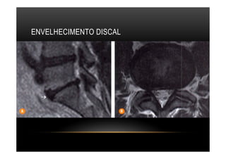 ENVELHECIMENTO DISCAL
 