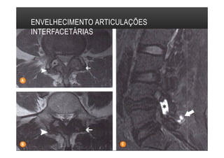ENVELHECIMENTO ARTICULAÇÕES
INTERFACETÁRIAS
 