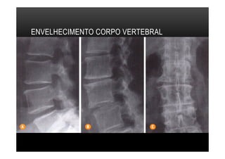 ENVELHECIMENTO CORPO VERTEBRAL
 