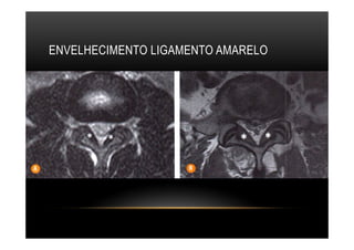 ENVELHECIMENTO LIGAMENTO AMARELO
 