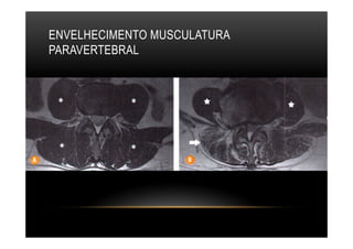 ENVELHECIMENTO MUSCULATURA
PARAVERTEBRAL
 
