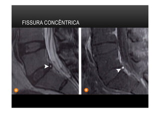 FISSURA CONCÊNTRICA
 
