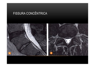 FISSURA CONCÊNTRICA
 