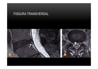 FISSURA TRANSVERSAL
 