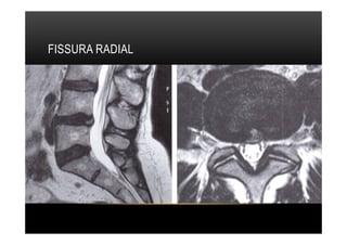 FISSURA RADIAL
 