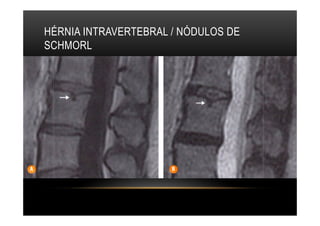 HÉRNIA INTRAVERTEBRAL / NÓDULOS DE
SCHMORL
 