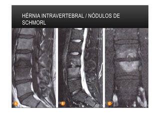 HÉRNIA INTRAVERTEBRAL / NÓDULOS DE
SCHMORL
 