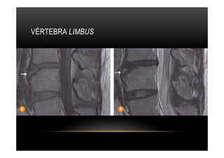 VÉRTEBRA LIMBUS
 
