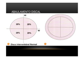 ABAULAMENTO DISCAL
 