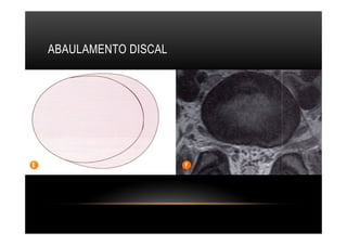 ABAULAMENTO DISCAL
 