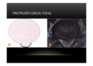 PROTRUSÃO DISCAL FOCAL
 