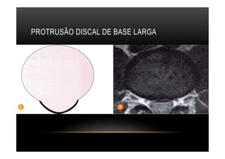 PROTRUSÃO DISCAL DE BASE LARGA
 