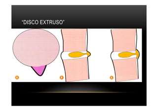 “DISCO EXTRUSO”
 