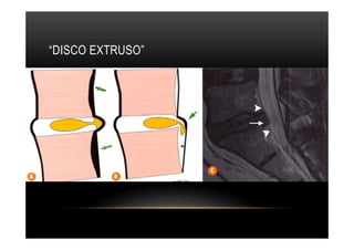 “DISCO EXTRUSO”
 