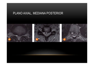 PLANO AXIAL, MEDIANA POSTERIOR
 