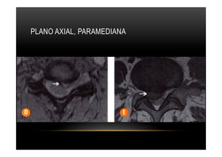 PLANO AXIAL, PARAMEDIANA
 